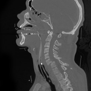 Whiplash From a Car Accident