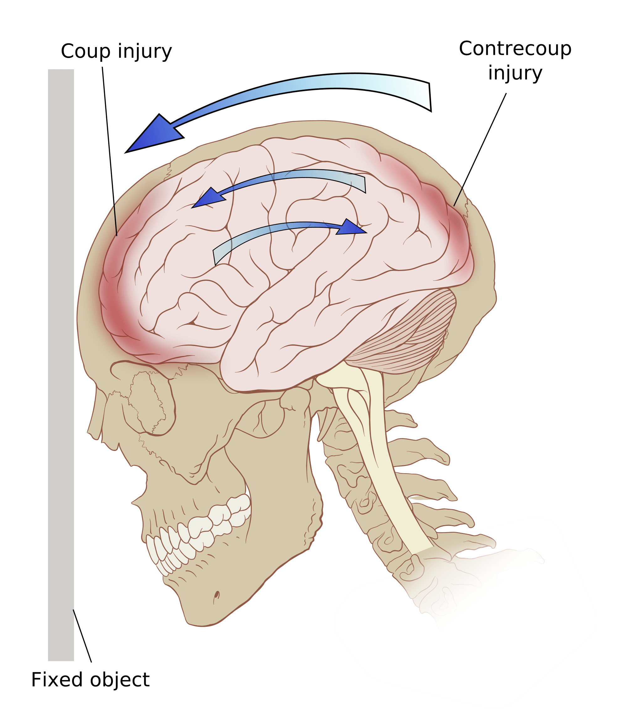 finding-the-best-treatment-for-traumatic-brain-injury-tbi