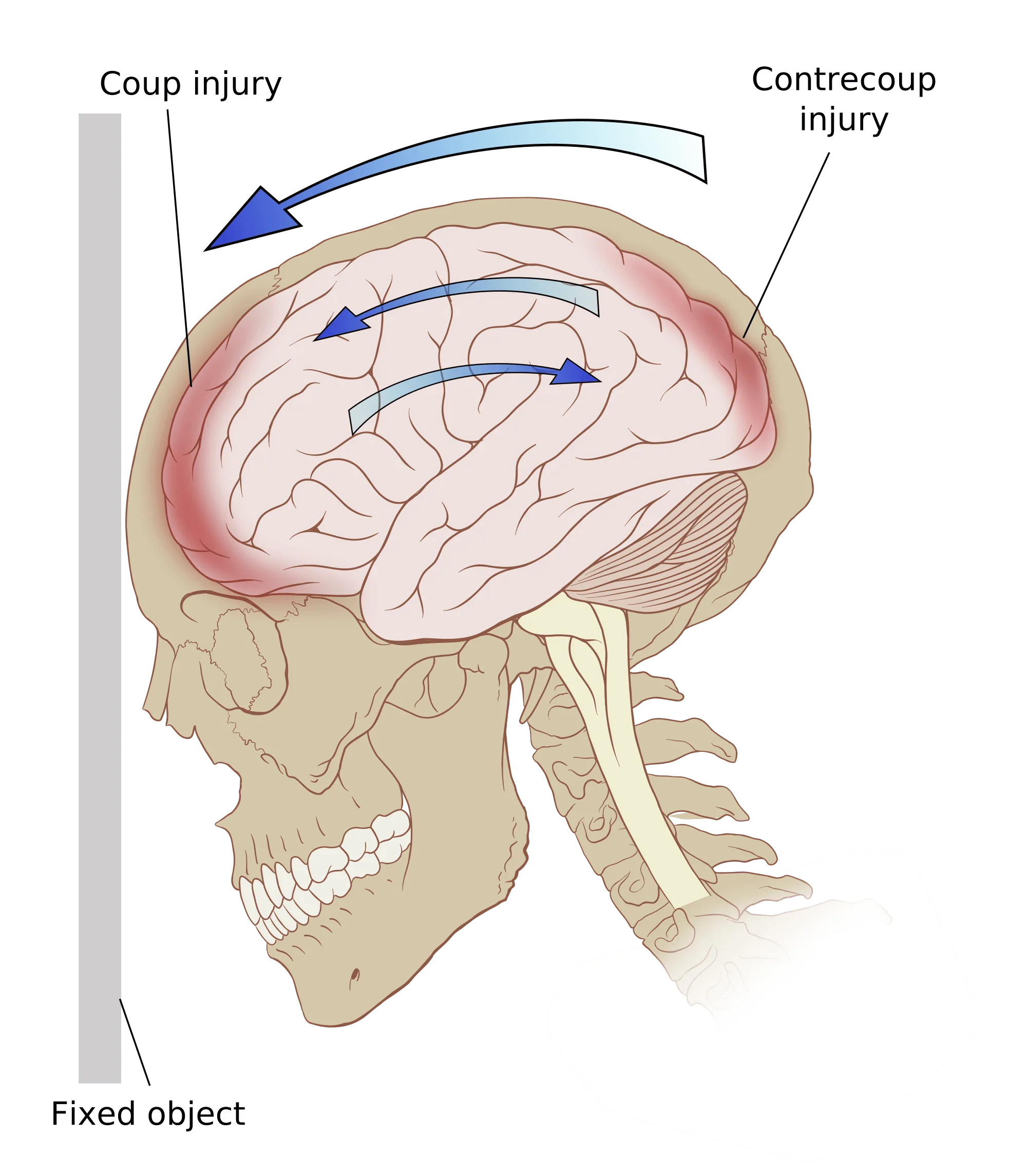 Choosing TBI Rehabilitation
