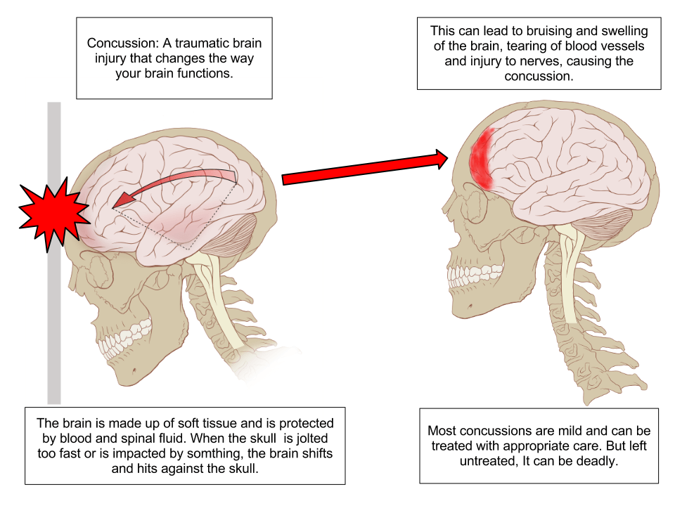 What To Do If You Think You Got Concussion