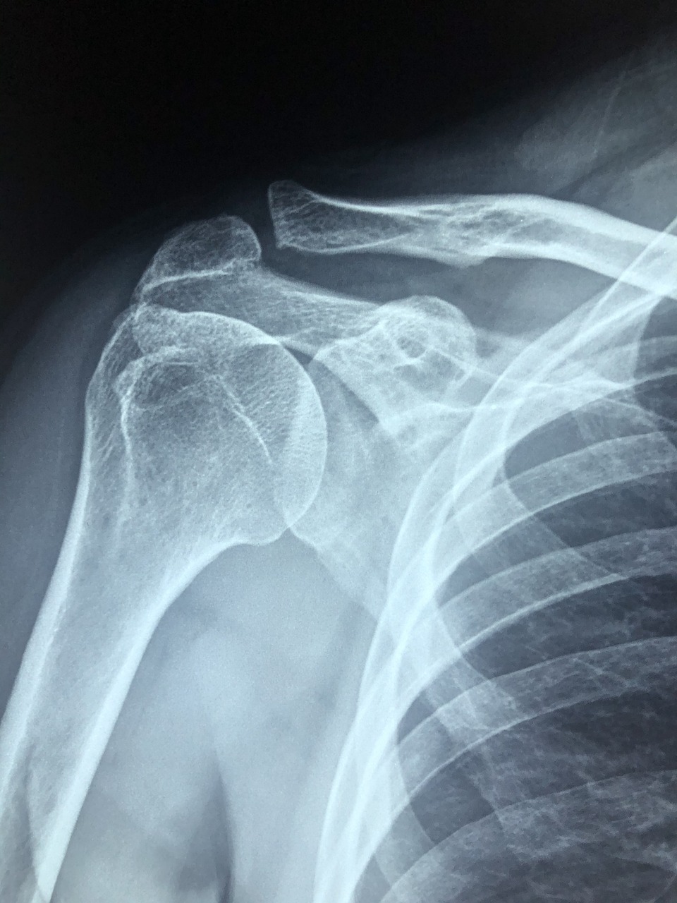 Synthes/Norian Bone Cement Blamed for Patient Deaths
