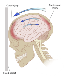 Choosing TBI Rehabilitation