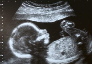 Birth Injury Statistics in America