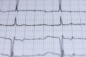Fetal Bradycardia Birth Injuries