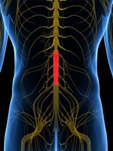 Dallas Cauda Equina Syndrome Lawyers