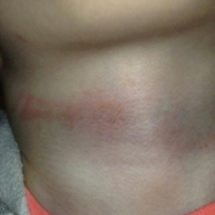 Daycare Abuse of a Child