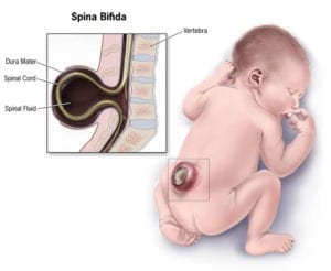 Spina Bifida Birth Defect Lawsuit
