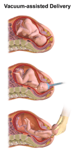 Ventouse Delivery Lawyer in Dallas